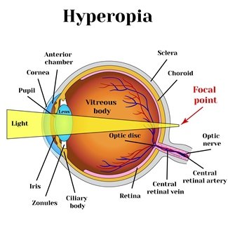 Illustration décrivant l'hypermétropie